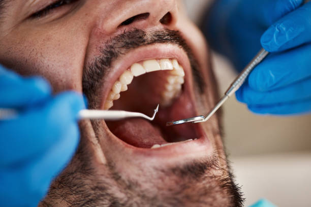 Best Emergency Wisdom Teeth Removal in San Clemente, CA